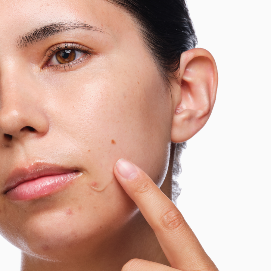 the-acne-set-r2 rdn-the-acne-set-application.png
