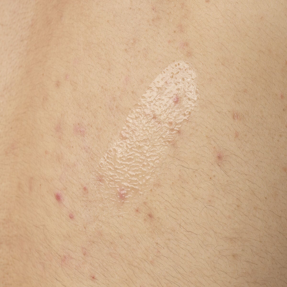 salicylic-acid-0-5-body-serum-a2 ORD-salicylic-acid-05-body-240ml-application.jpg