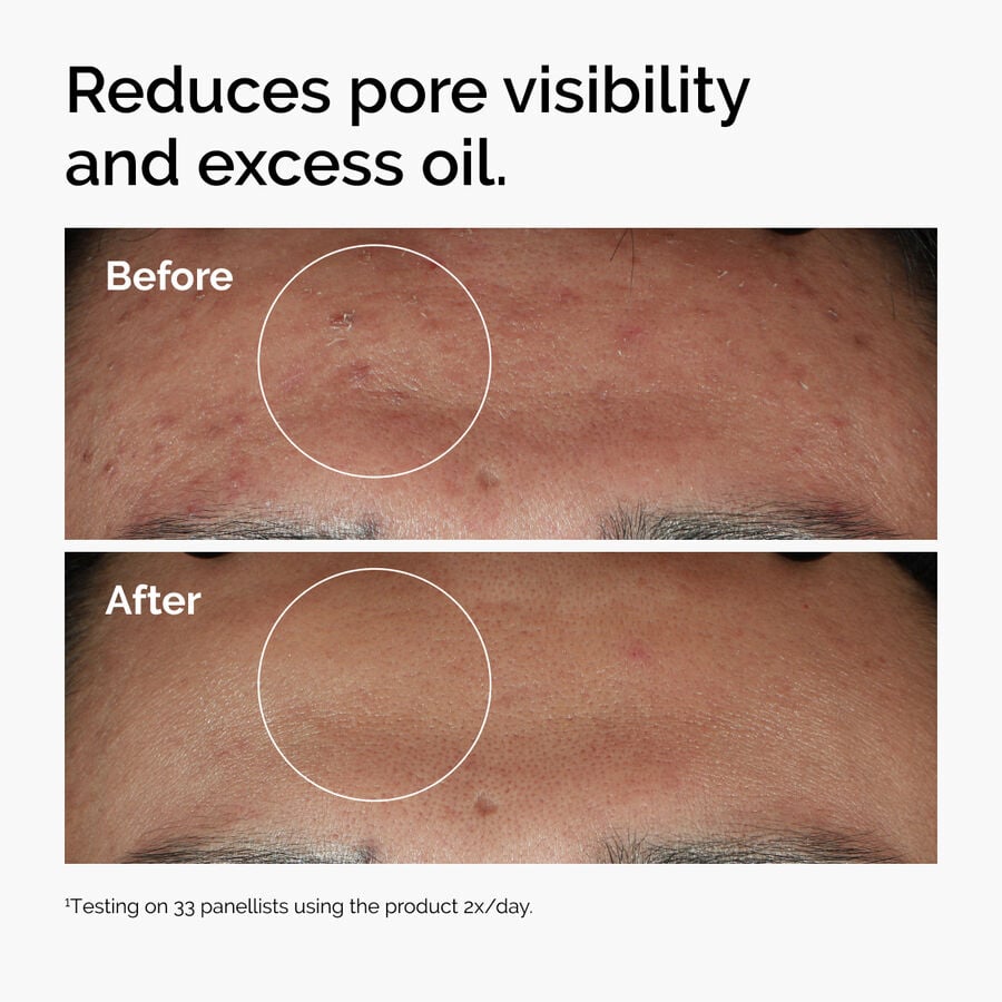 niacinamide-10-zinc-1-z7 ord-niacinamide-zinc-blemish-serum-before-after-pores.jpg