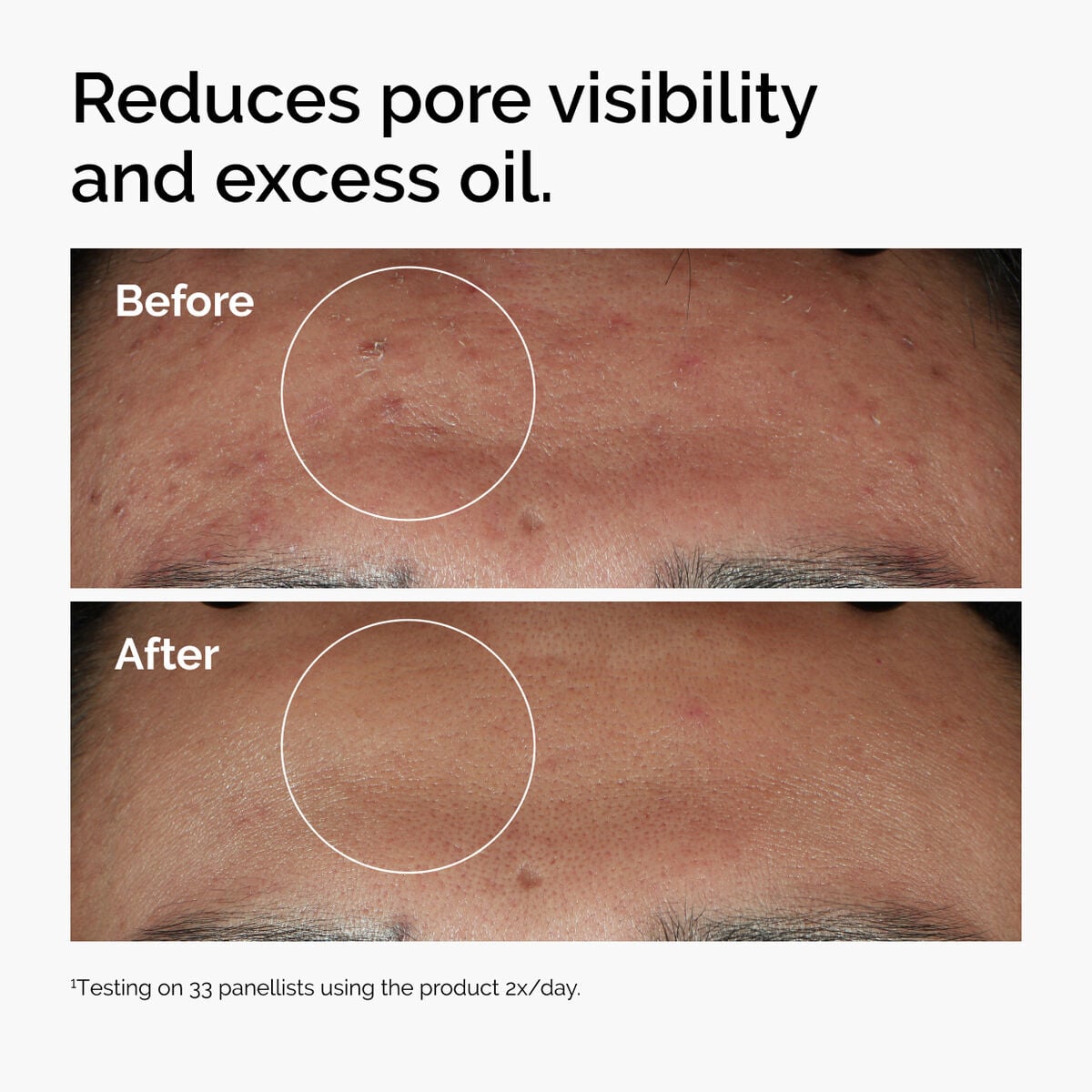 niacinamide-10-zinc-1-z7 ord-niacinamide-zinc-blemish-serum-before-after-pores.jpg