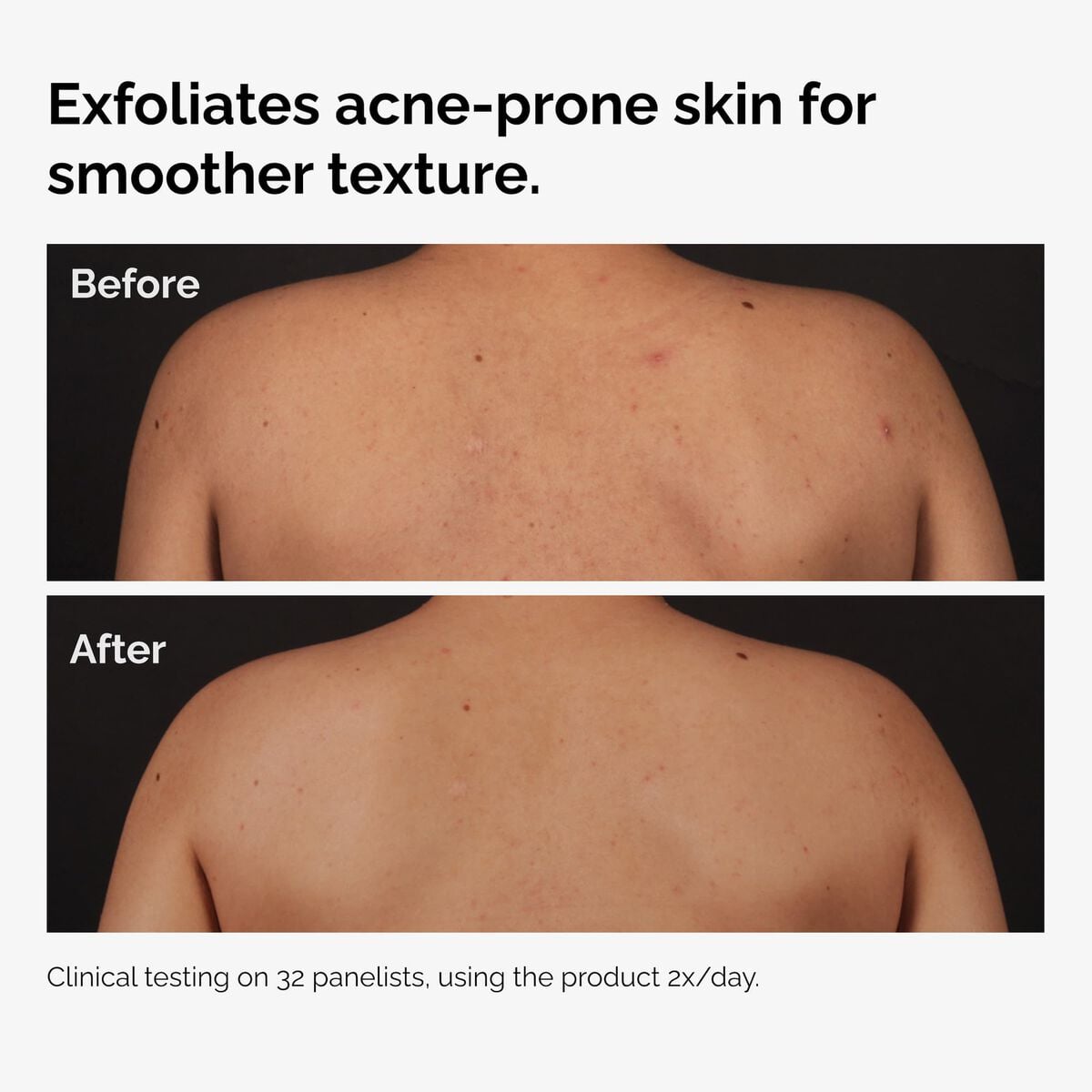 salicylic-acid-0-5-body-serum-a2 ord-salicylic-acid-body-serum-before-after-graphic-NA.jpg